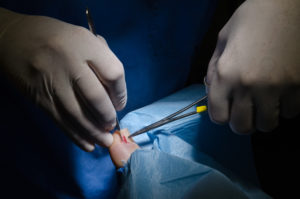 intervento Unghia incarnita chirurgia