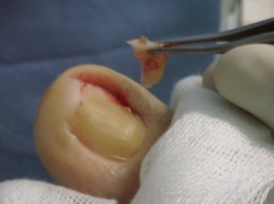 chirurgia unghia incarnita con fenolizzazione